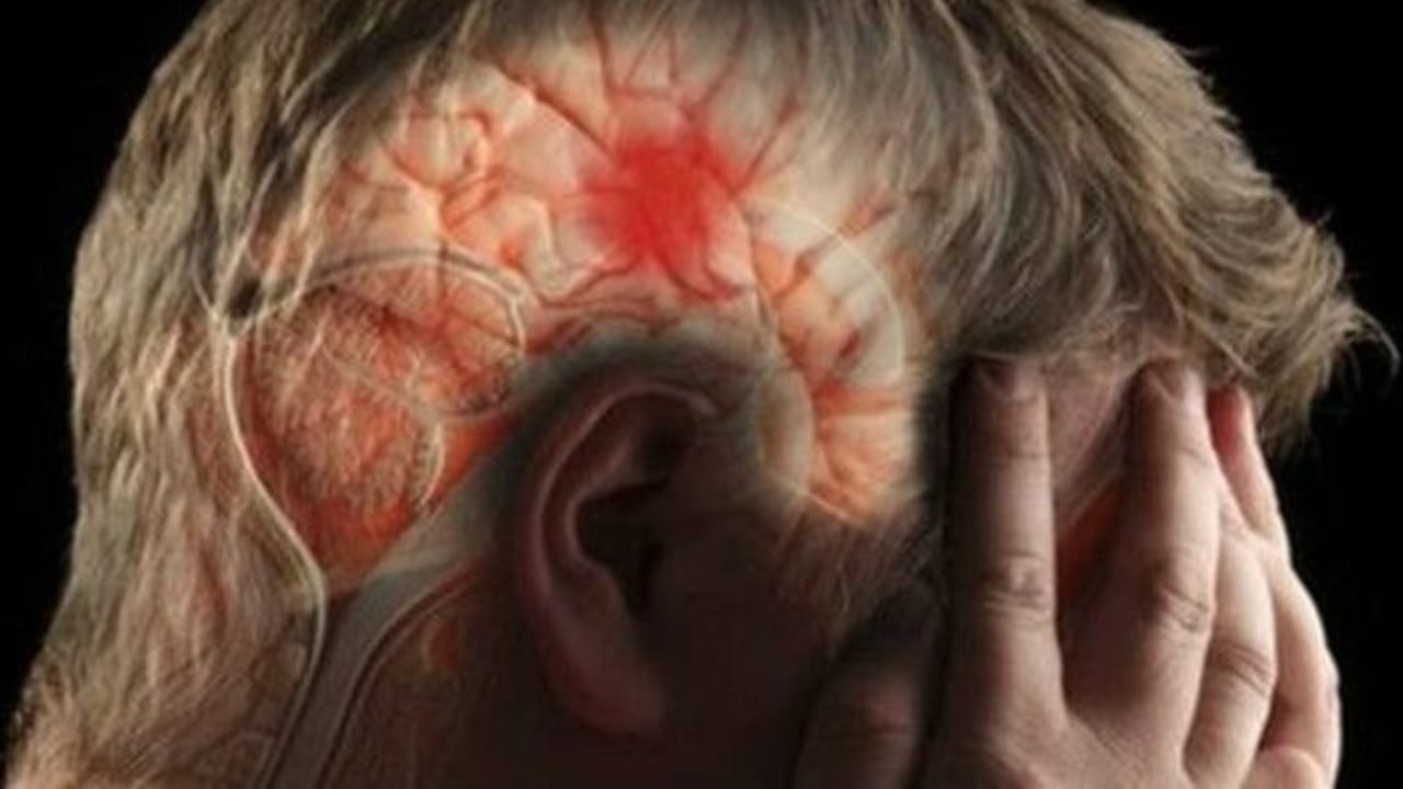  Infarto cerebral: síntomas para detectarlo a tiempo.